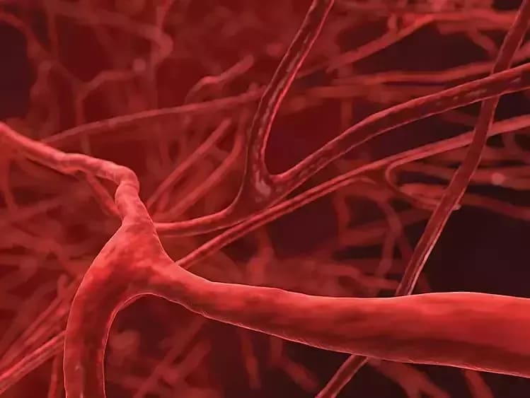 Tưởng bị tiền đình hóa phình mạch máu não
