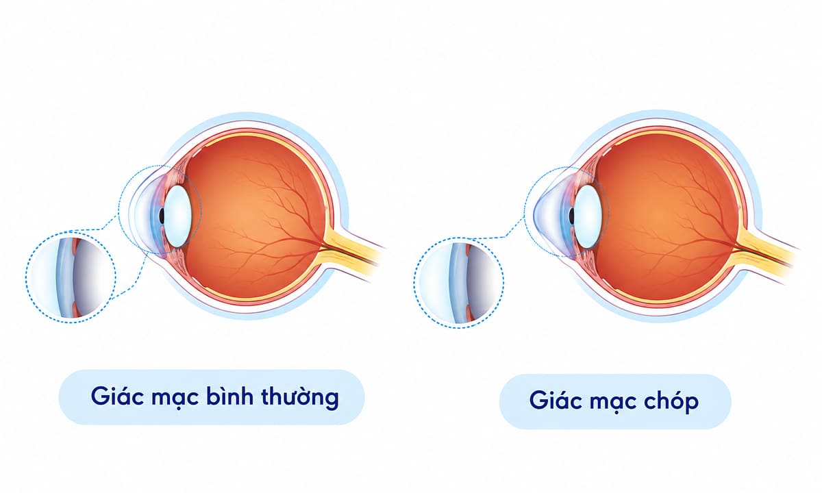 Giác mạc chóp
