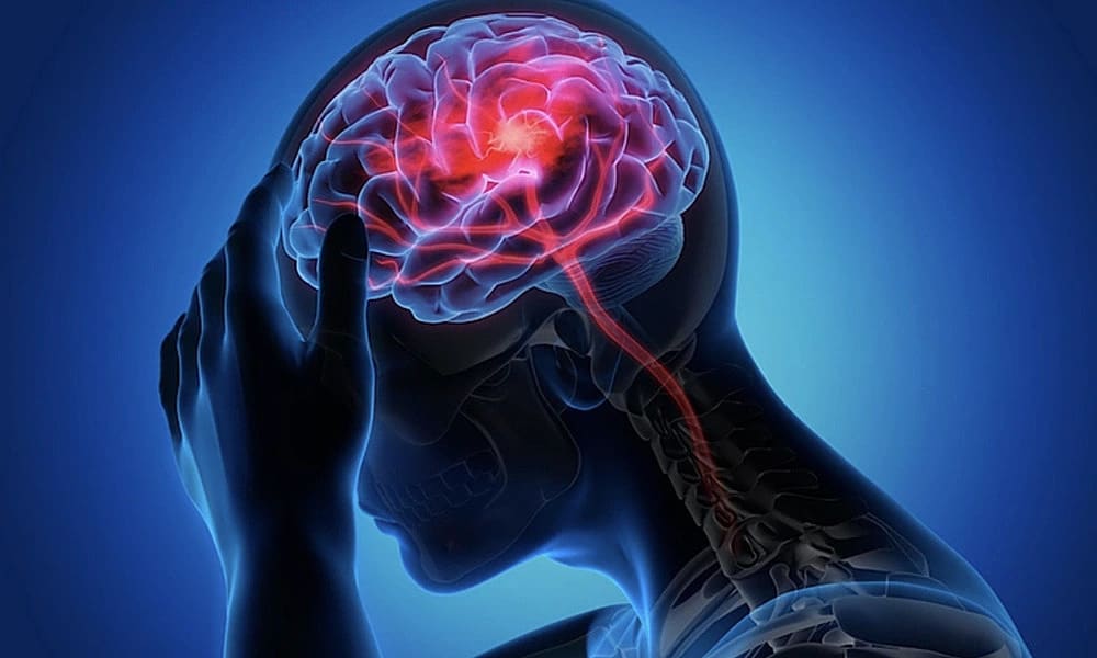 Đột quỵ vẫn đi làm bởi nghĩ 'phải bất tỉnh mới bệnh'