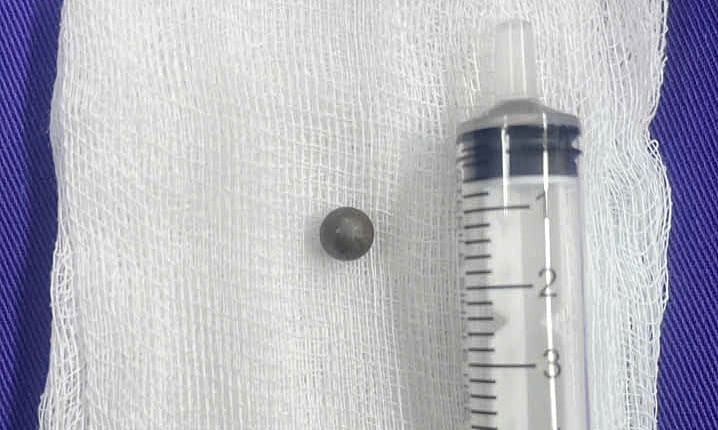 Bé trai bị bi sắt đâm xuyên mắt, nằm sát nền sọ