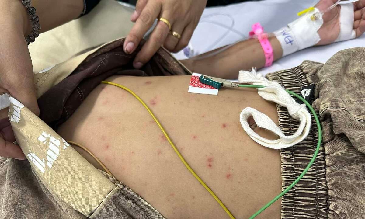 Não mô cầu có thể trở nặng sau vài giờ đau đầu