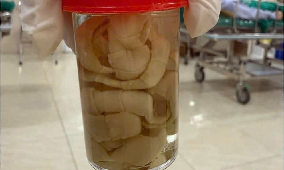 Sán dài 1,2 m ký sinh trong bụng người đàn ông