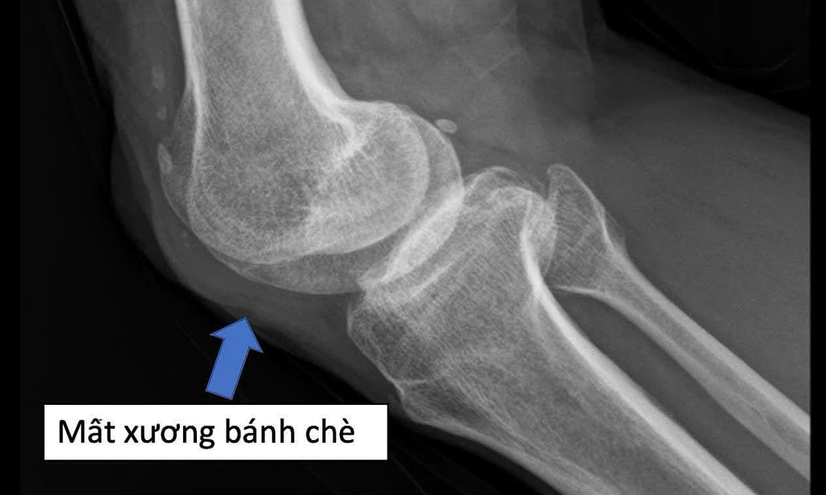 Nối mạch cứu đôi chân thương binh mất xương bánh chè nửa thế kỷ