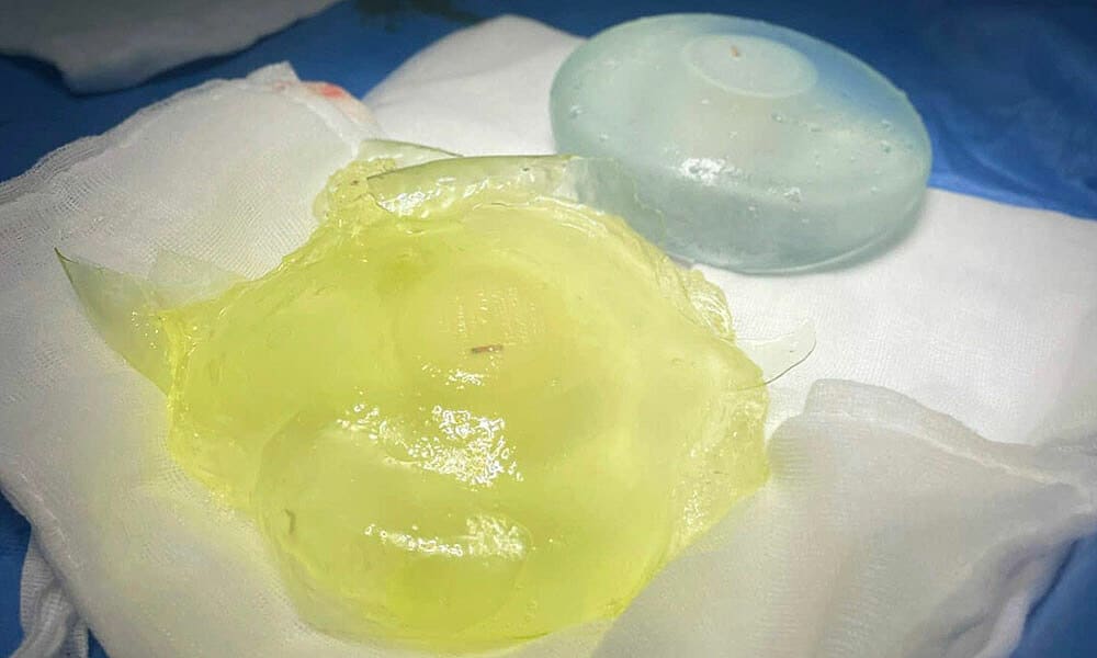 Dấu hiệu phản ánh bất thường ở khoang đặt túi ngực