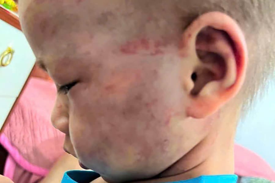 Отчим задержан за избиение 3-летнего «сотрясения мозга»