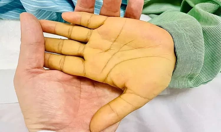 Viêm gan A, B, C, D, E lây nhiễm và hại cơ thể thế nào